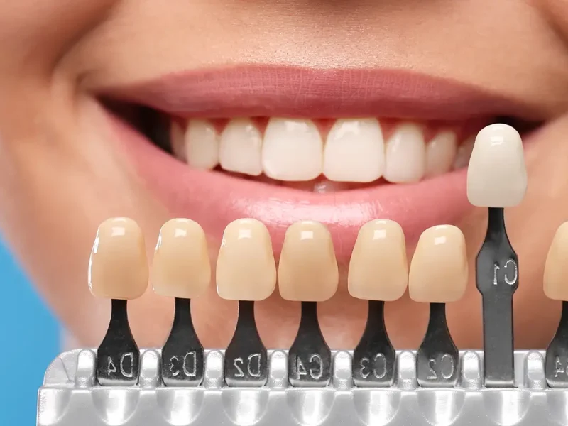 Veneers-header-mobil